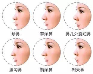 鼻子整形有幾種方法？哪里隆鼻比較好？徐州優(yōu)儷智美怎么樣？