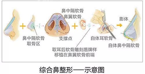 鼻子整形有幾種方法？哪里隆鼻比較好？徐州優(yōu)儷智美怎么樣？