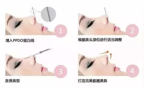 鼻子整形有幾種方法？哪里隆鼻比較好？徐州優(yōu)儷智美怎么樣？