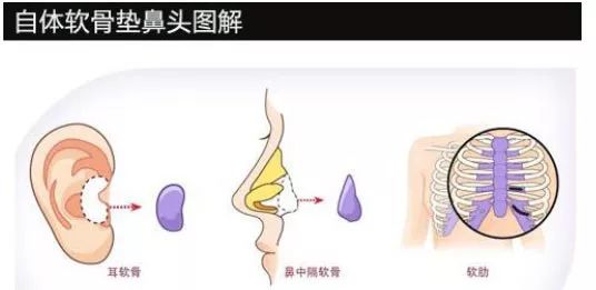 鼻子整形有幾種方法？哪里隆鼻比較好？徐州優(yōu)儷智美怎么樣？