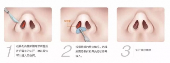 鼻子整形有幾種方法？哪里隆鼻比較好？徐州優(yōu)儷智美怎么樣？
