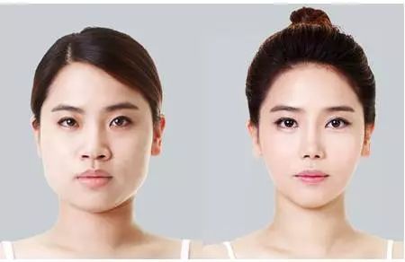 瘦臉攻略，想瘦臉的看過來，徐州優(yōu)儷智美整形醫(yī)院瘦臉針